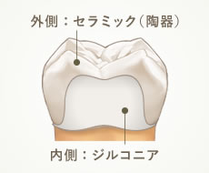 外側：セラミック（陶器）内側：ジルコニア