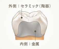 外側：セラミック（陶器） 内側：金属