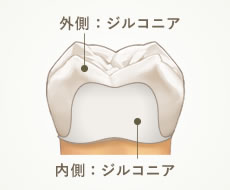 外側：ジルコニア　内側：ジルコニア