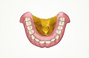 金属床義歯 