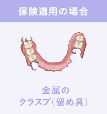 保険適用の場合：金属のクラスプ（留め具）