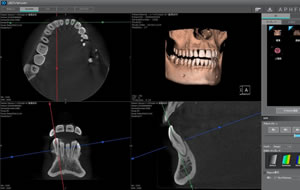 歯科用3D（立体）CT