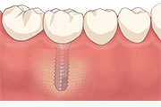 インプラント