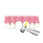 歯間や歯面をクリーニング